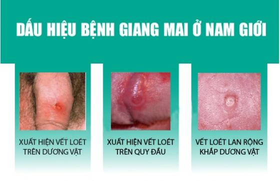 giang-mai-dau-hieu.jpg