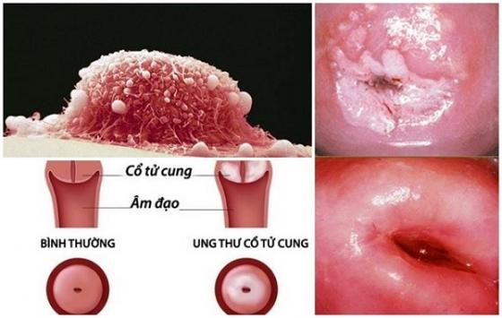 1759553174126477.jpg ung-thu-o-tu-cung_1.jpg