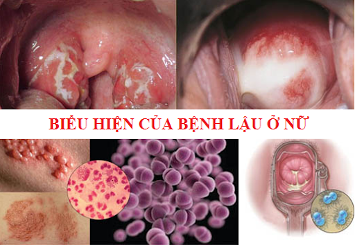 1761550072180028.png bệnh-lậu-ở-nữ-giới (1).png